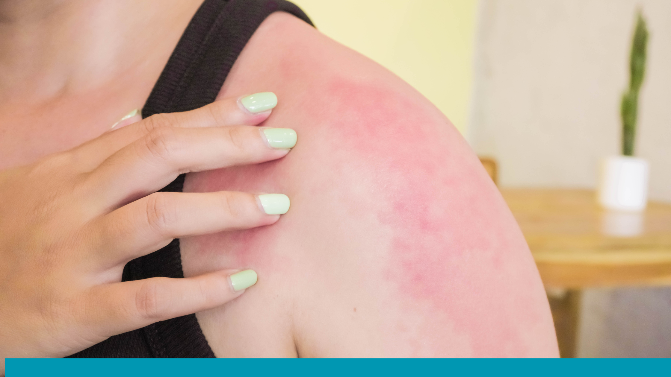 Sunburn: Symptoms, Causes, Treatments, and Prevention